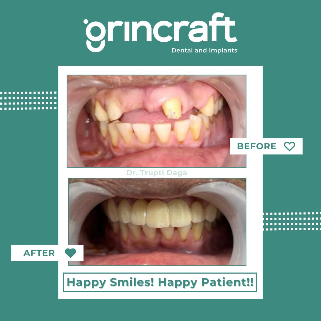 Smile transformation